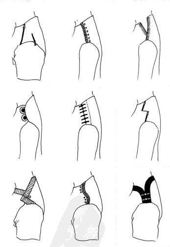 Множество вариантов застёжек на плече